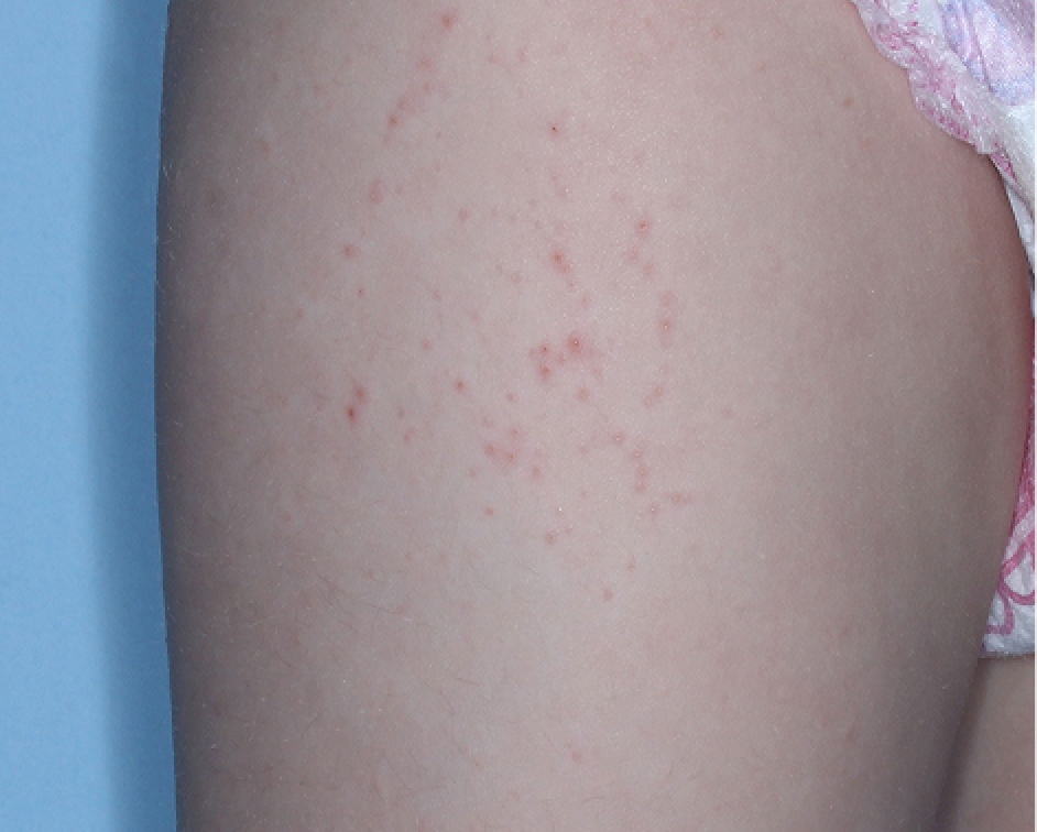 Upper Leg with atopic dermatitis before treatment - Baseline vIGA-AD = 2