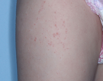 Upper Leg with atopic dermatitis before treatment - Baseline vIGA-AD = 2
