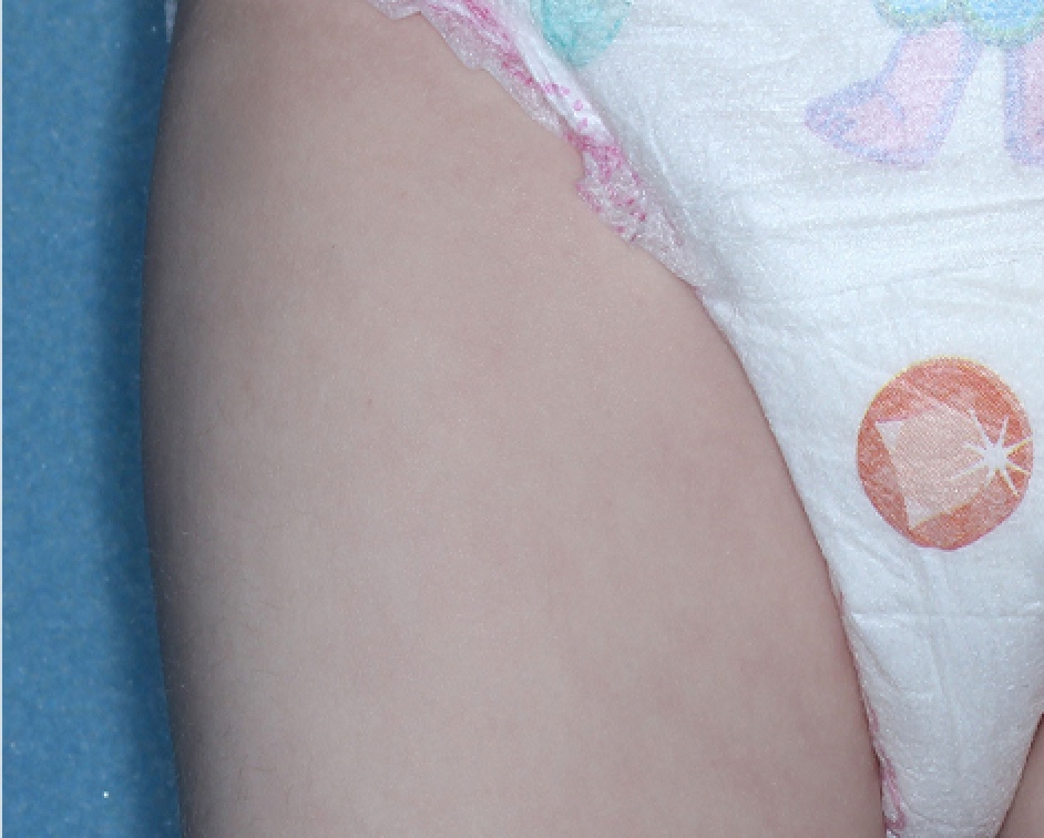 Upper Leg with atopic dermatitis on Week 4 of treatment - vIGA-AD = 0