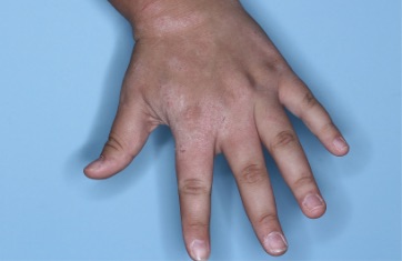 Hand with atopic dermatitis before treatment - Baseline vIGA-AD = 3