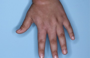 Hand with atopic dermatitis on Week 1 of treatment - vIGA-AD = 2