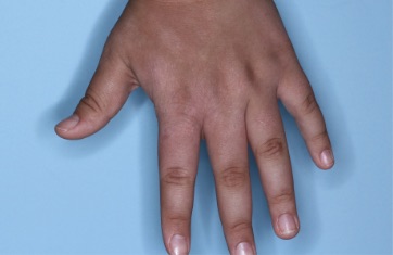 Hand with atopic dermatitis on Week 4 of treatment - vIGA-AD = 1