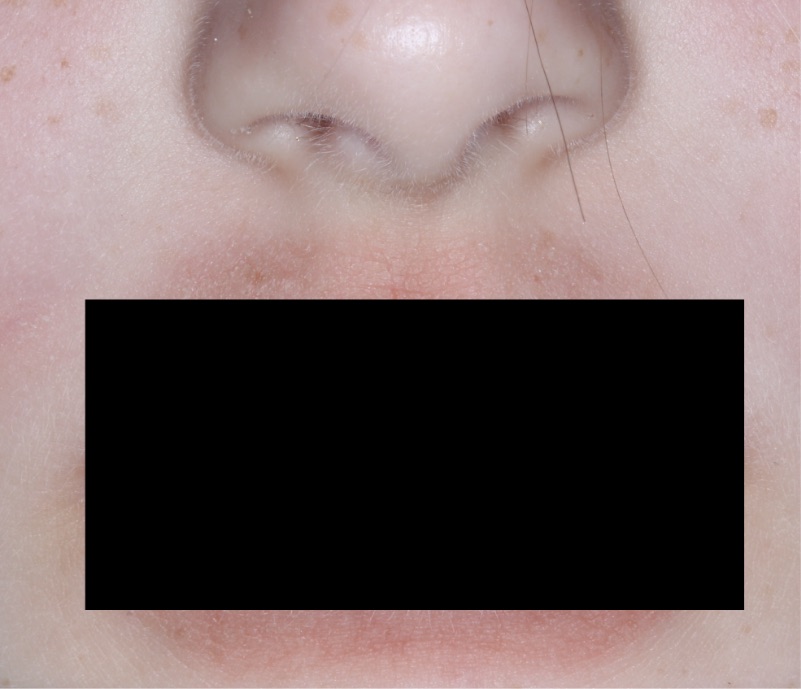 Mouth with atopic dermatitis before treatment - Baseline vIGA-AD = 3