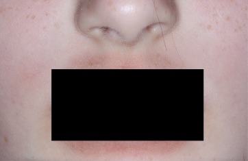 Mouth with atopic dermatitis before treatment - Baseline vIGA-AD = 3