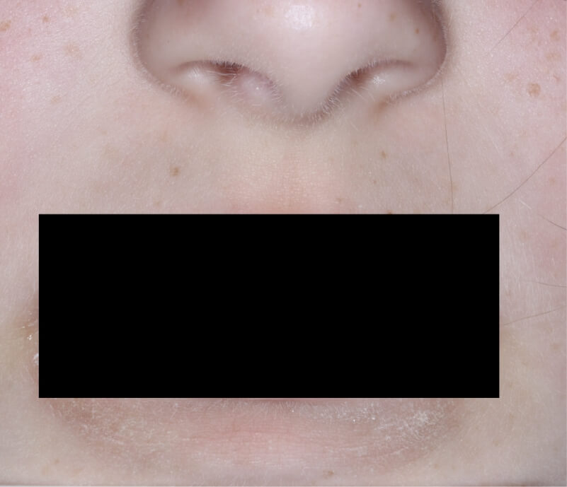 Mouth with atopic dermatitis on Week 1 of treatment - vIGA-AD = 1