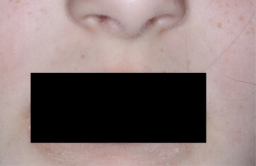 Mouth with atopic dermatitis on Week 1 of treatment - vIGA-AD = 1