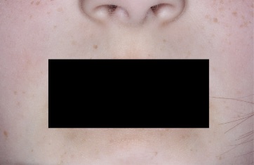 Mouth with atopic dermatitis on Week 4 of treatment - vIGA-AD = 0