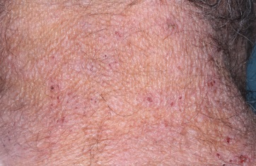 Neck with atopic dermatitis before treatment - Baseline vIGA-AD = 3