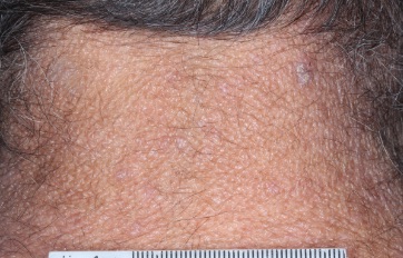 Neck with atopic dermatitis on Week 1 of treatment - vIGA-AD = 2