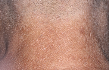 Neck with atopic dermatitis on Week 4 of treatment - vIGA-AD = 1