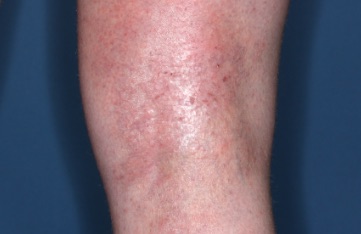 Popliteal Fossa with atopic dermatitis before treatment - Baseline vIGA-AD = 3