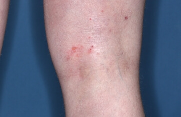 Popliteal Fossa with atopic dermatitis on Week 1 of treatment - vIGA-AD = 2