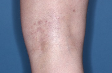 Popliteal Fossa with atopic dermatitis on Week 4 of treatment - vIGA-AD = 1