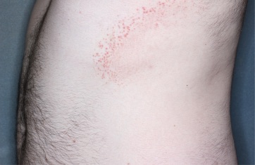 Trunk with atopic dermatitis before treatment - Baseline vIGA-AD = 3