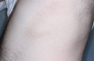 Trunk with atopic dermatitis on Week 1 of treatment - vIGA-AD = 2