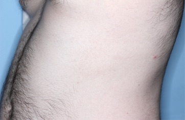 Trunk with atopic dermatitis on Week 4 of treatment - vIGA-AD = 1