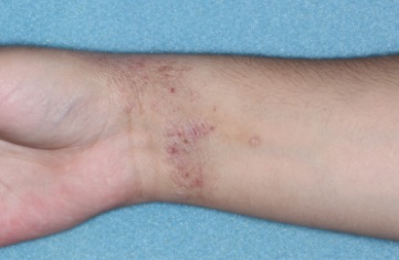 Wrist with atopic dermatitis before treatment - Baseline vIGA-AD = 3