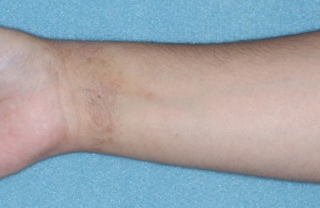 Wrist with atopic dermatitis on Week 1 of treatment - vIGA-AD = 2