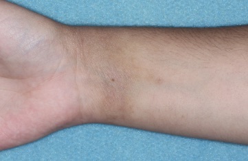 Wrist with atopic dermatitis on Week 4 of treatment - vIGA-AD = 0