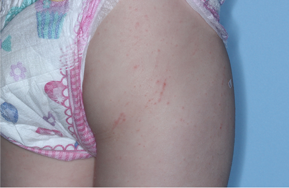 Gluteal region with atopic dermatitis before treatment - Baseline vIGA-AD = 2
