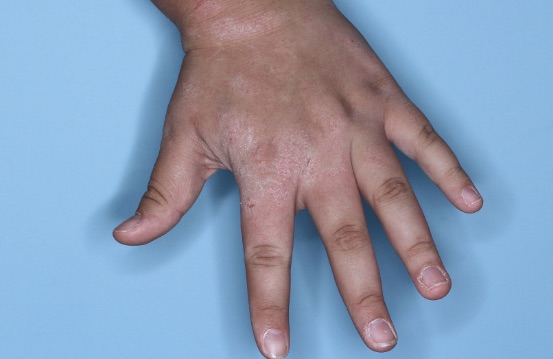 Hand with atopic dermatitis before treatment - Baseline vIGA-AD = 3