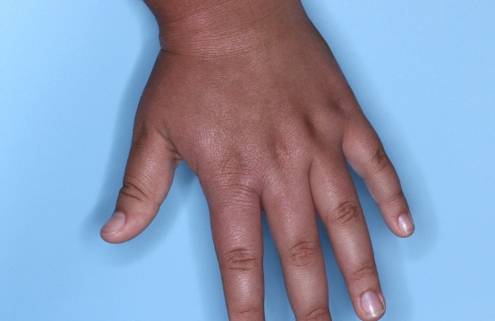 Hand with atopic dermatitis on Week 4 of treatment - vIGA-AD = 1