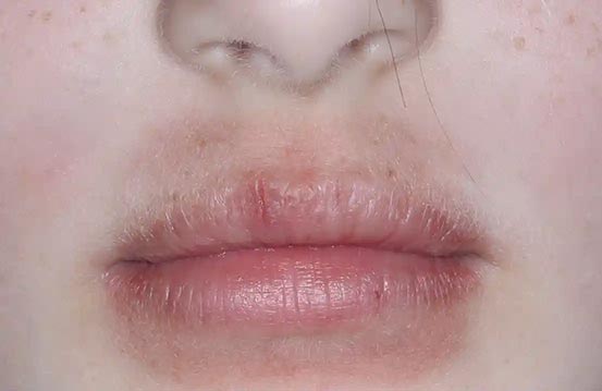 Mouth with atopic dermatitis before treatment - Baseline vIGA-AD = 3