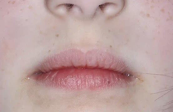 Mouth with atopic dermatitis on Week 4 of treatment - vIGA-AD = 0