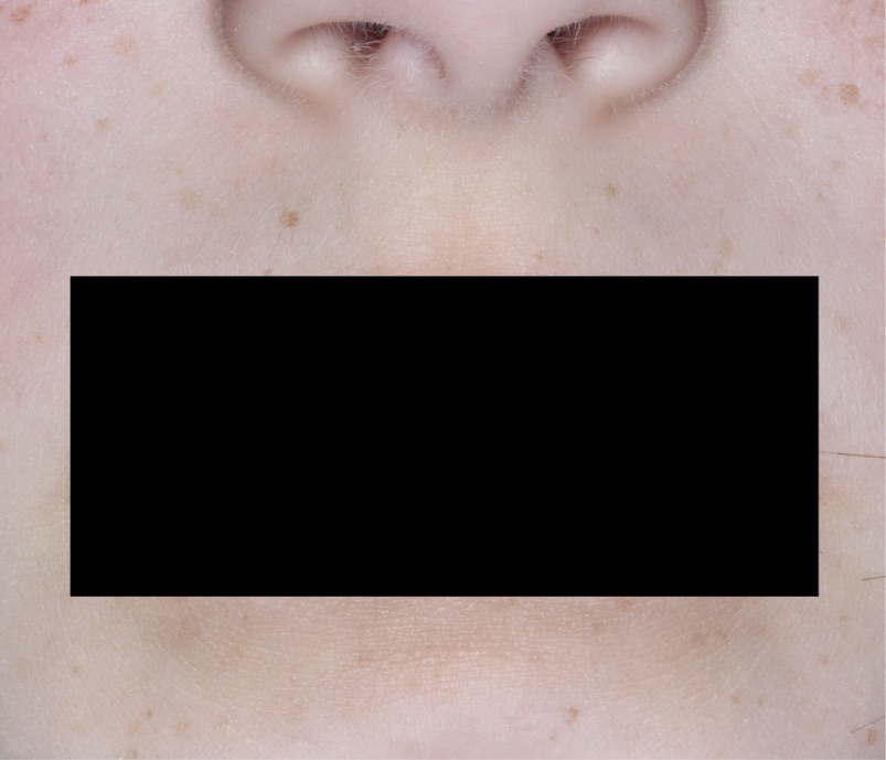 Mouth with atopic dermatitis on Week 4 of treatment - vIGA-AD = 0