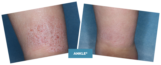 Photo of a clinical trial child's ankle before treatment and Week 4 photo of a clinical trial child's ankle on ZORYVE