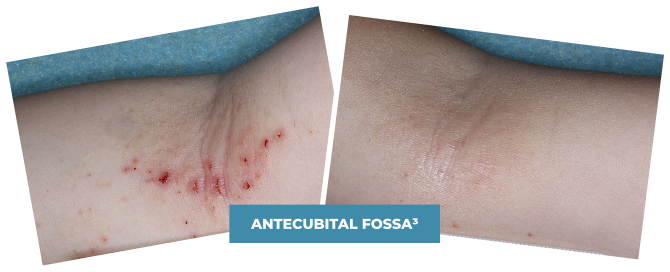 Photo of a clinical trial child's antecubital fossa before treatment and Week 4 photo of a clinical trial child's antecubital fossa on ZORYVE