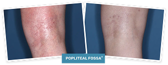 Photo of a clinical trial patient’s popliteal fossa before treatment and Week 4 photo of a clinical trial patient’s popliteal fossa on ZORYVE