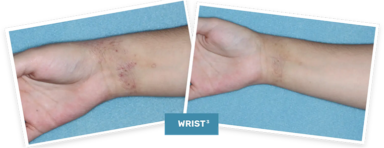 Photo of a clinical trial patient’s wrist before treatment and Week 4 photo of a clinical trial patient’s wrist on ZORYVE