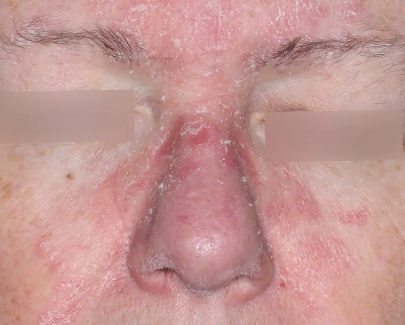 Image of face at baseline