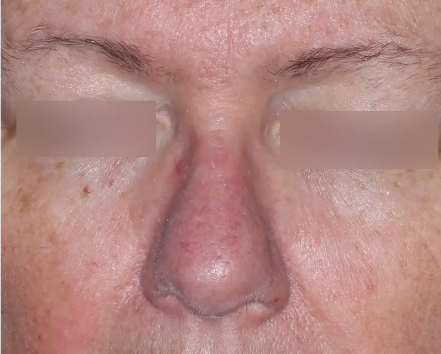 Image of face at week 2