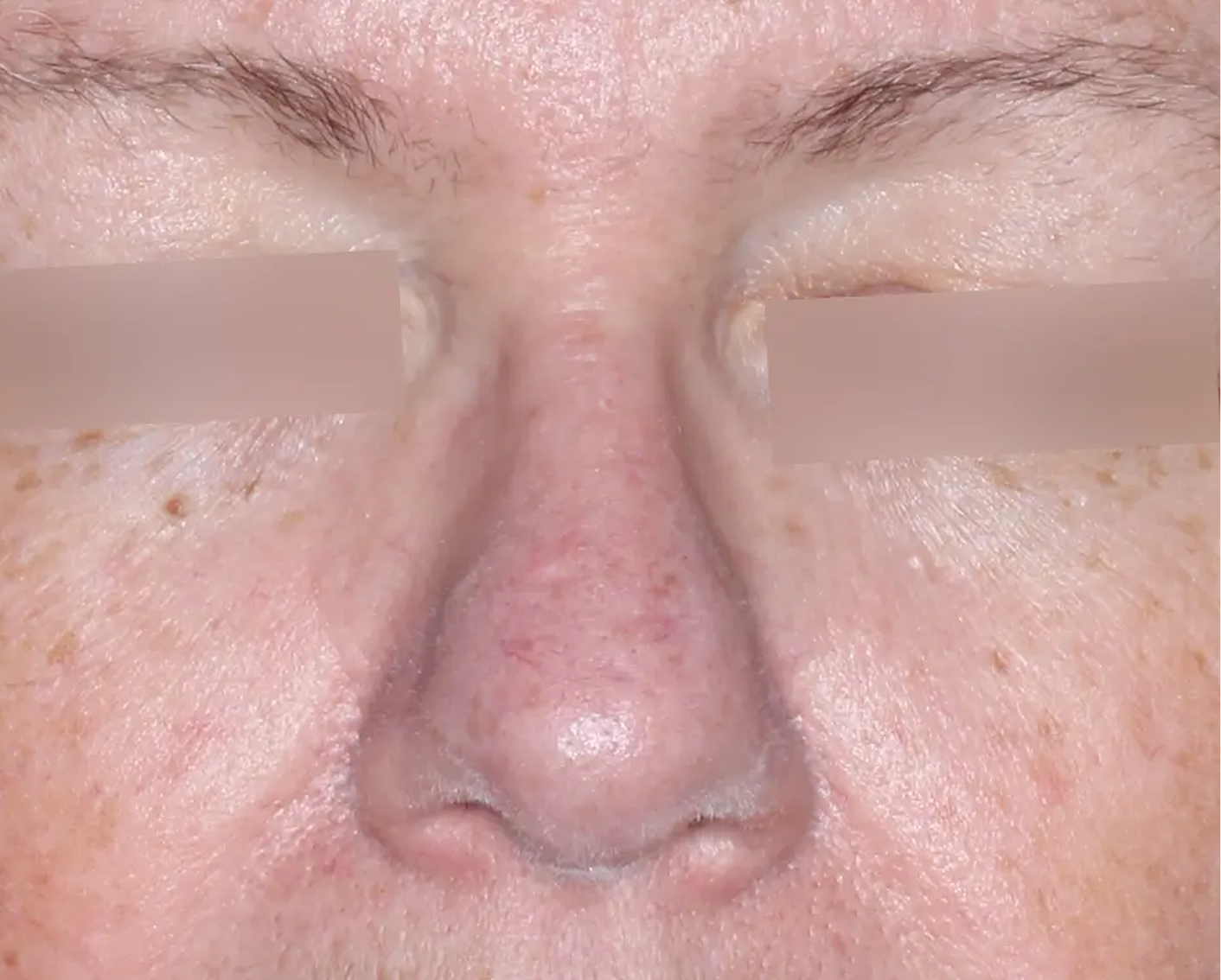 Image of face at week 4