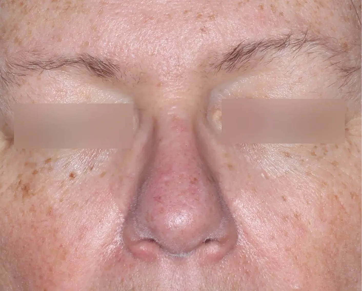 Image of face at week 8