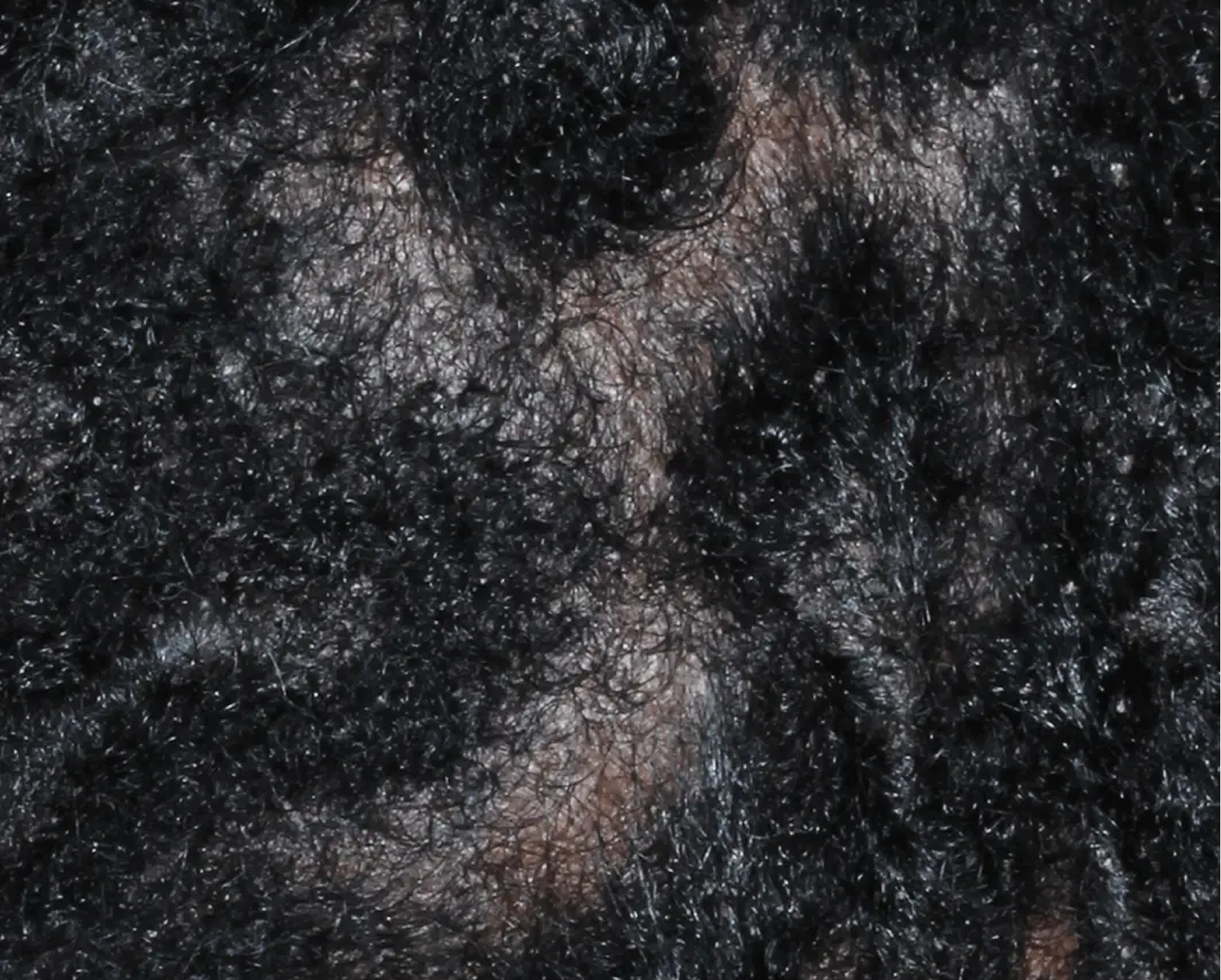 Image of scalp at baseline