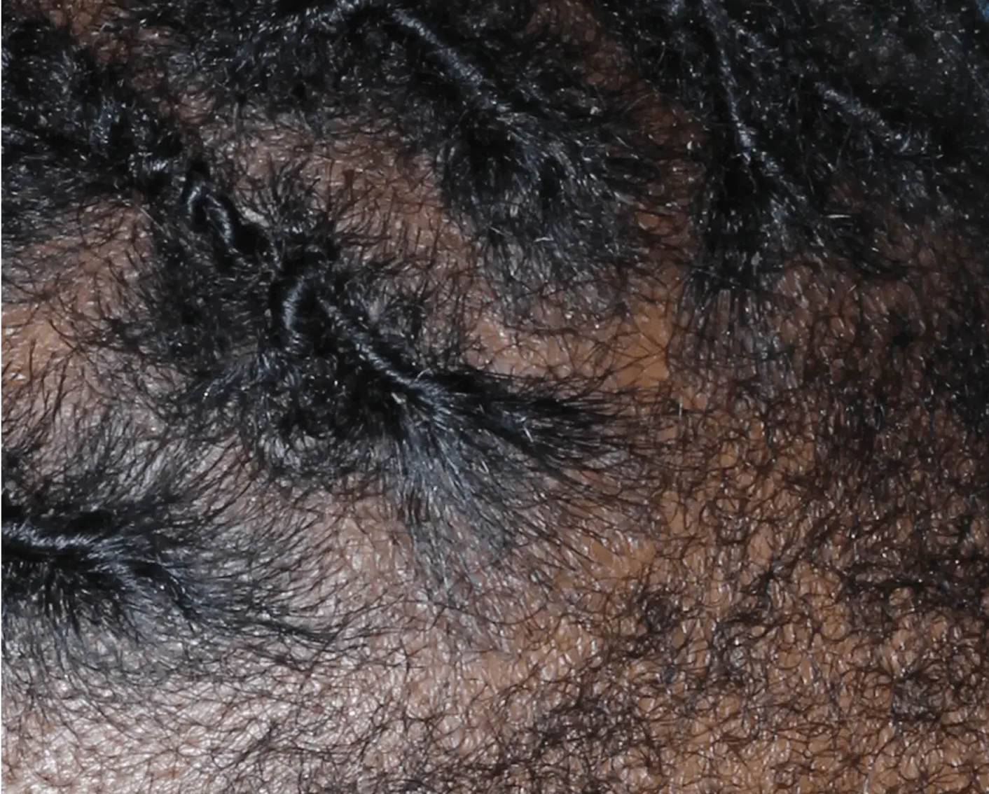 Image of scalp at week 2