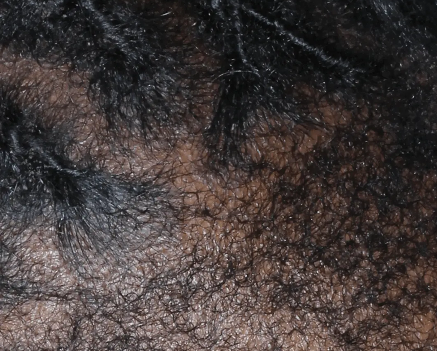 Image of scalp at week 4