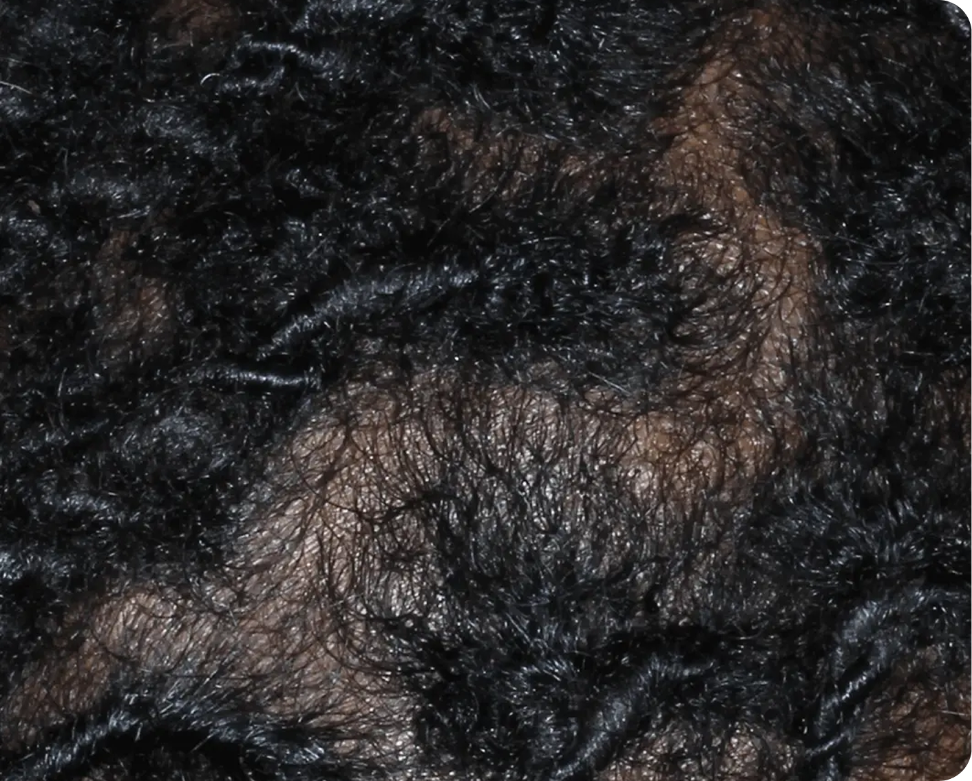 Image of scalp at week 8