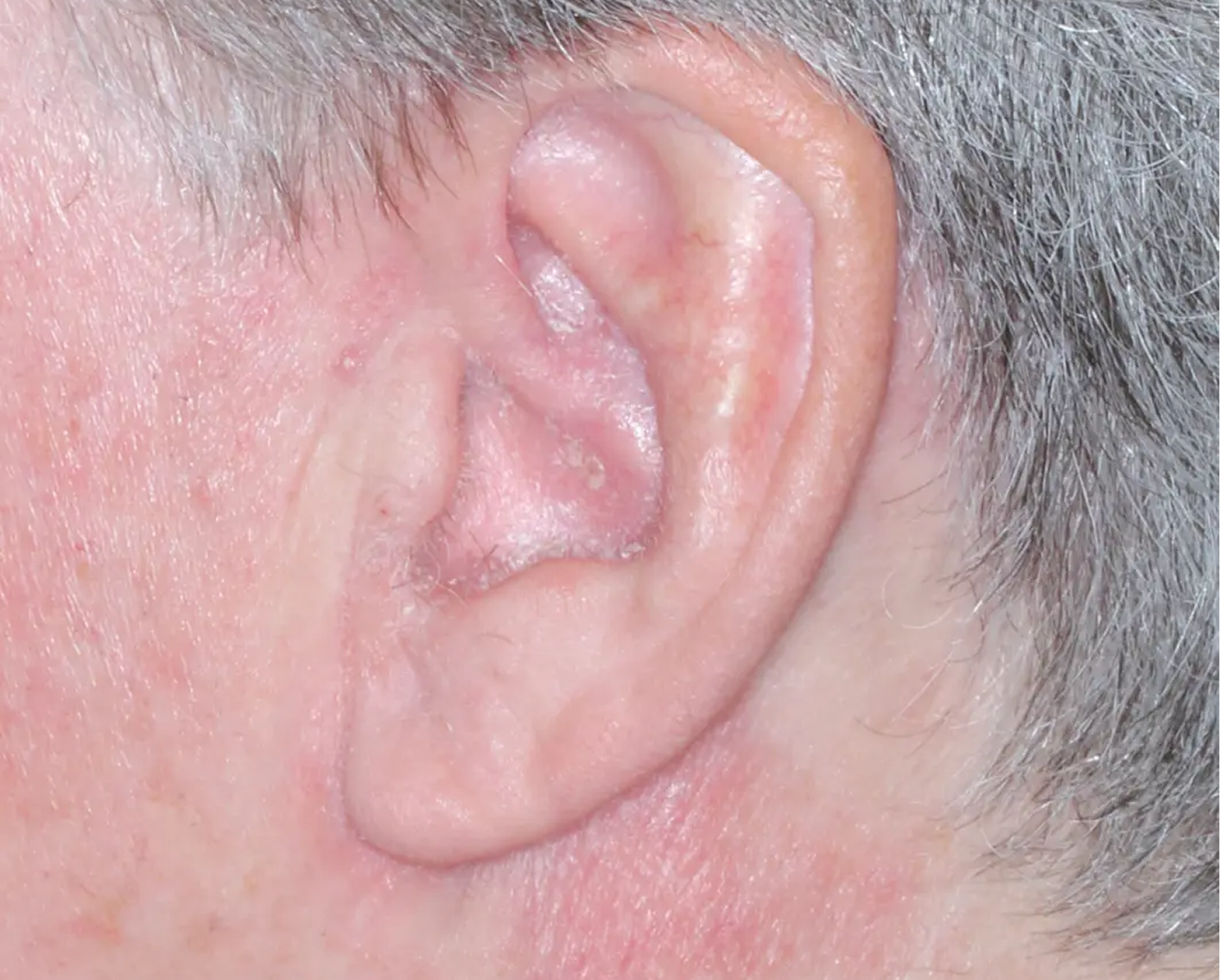 Image of ear at baseline