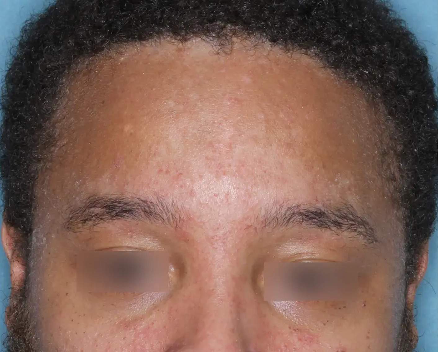 Image of forehead at baseline