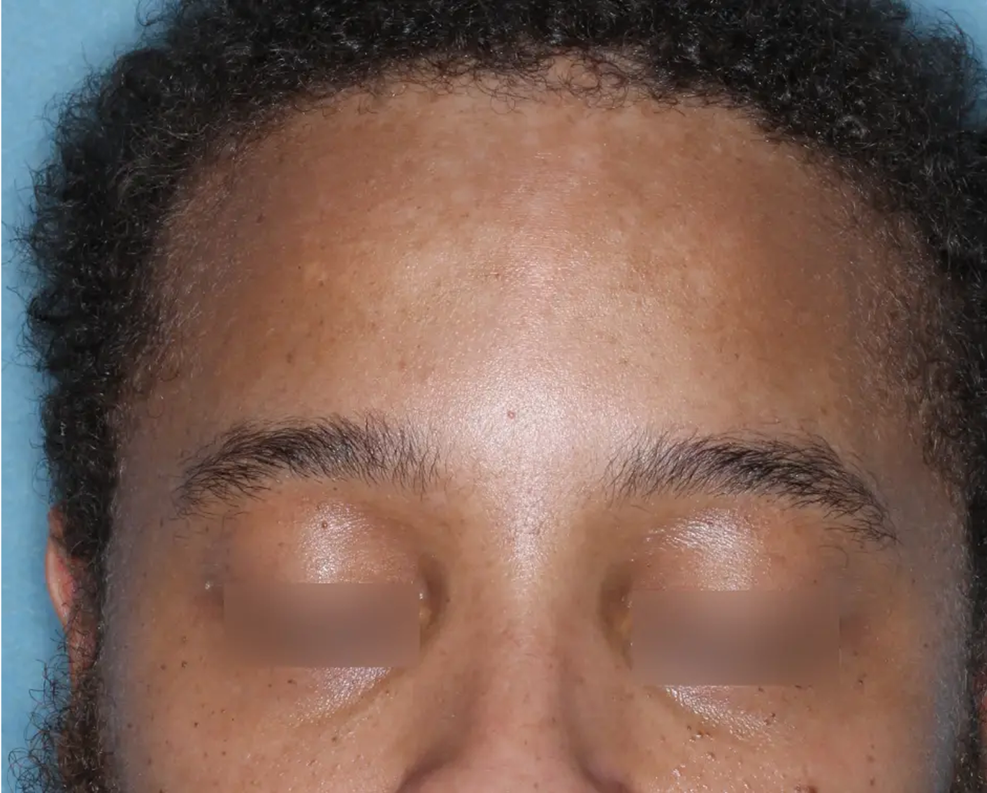 Image of forehead at week 2