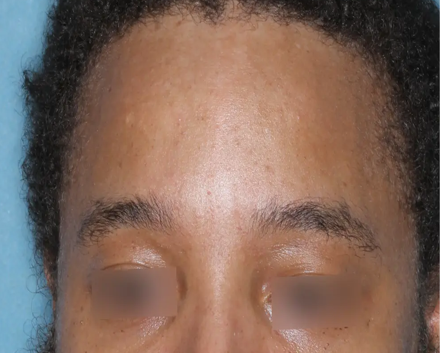 Image of forehead at week 4