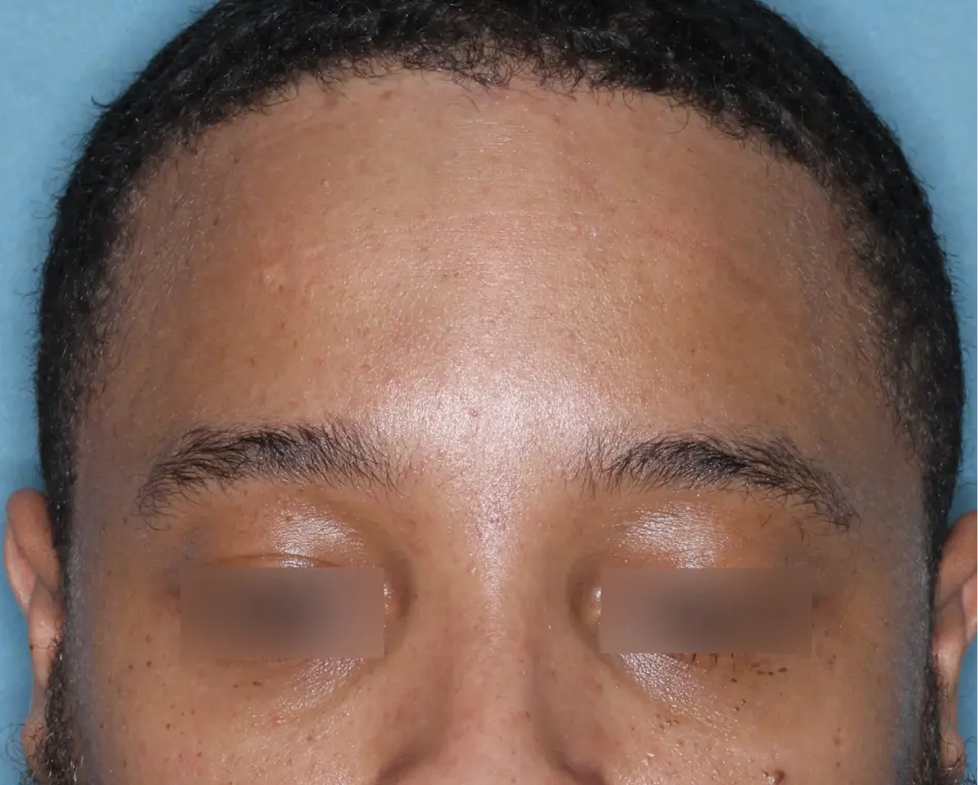 Image of forehead at week 8