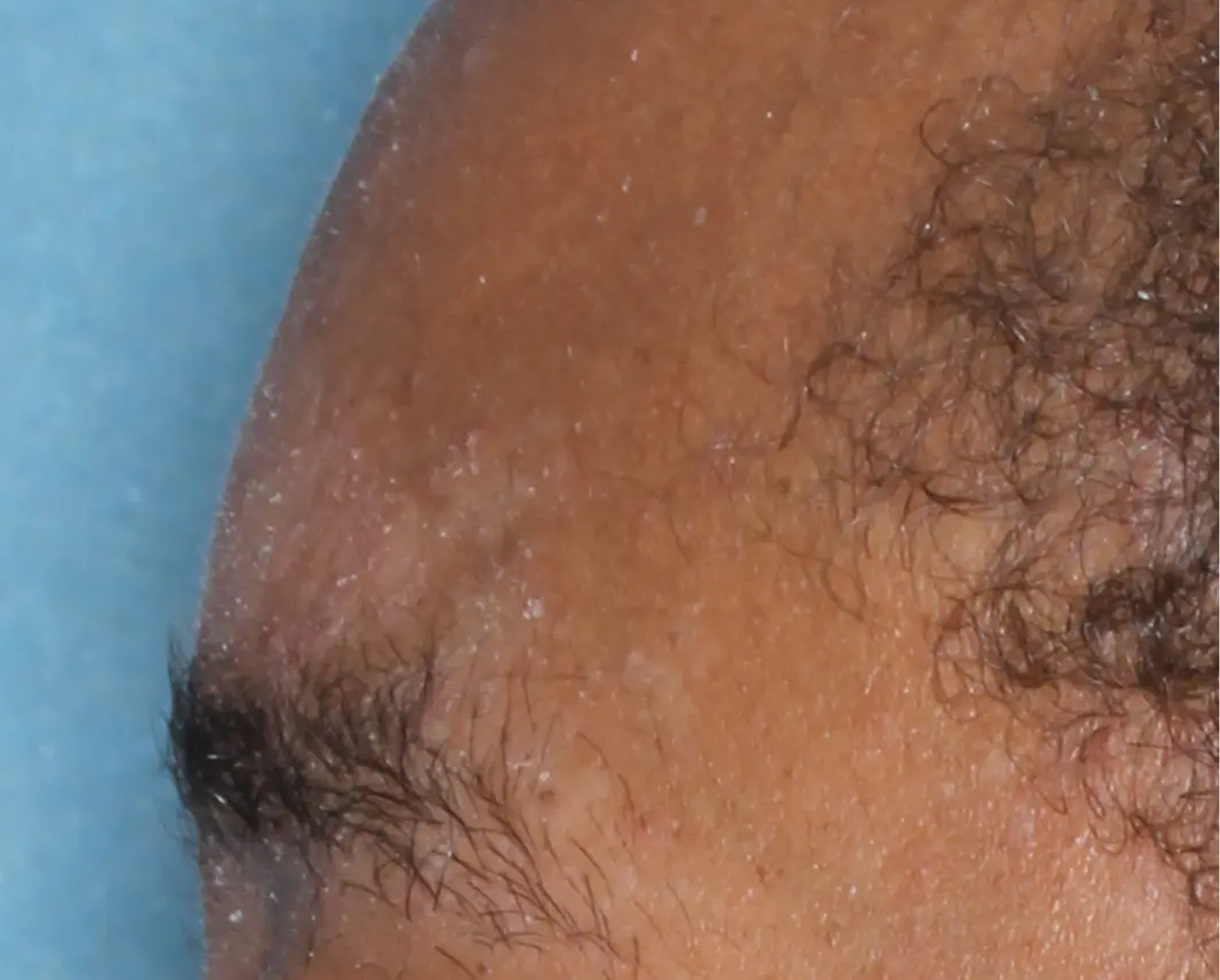 Image of eyebrow at baseline