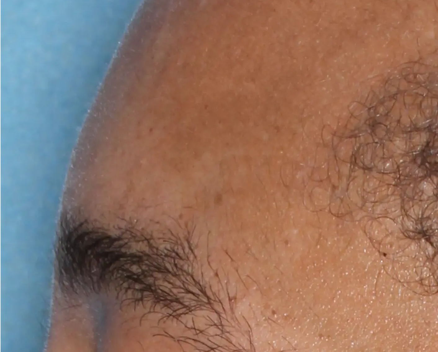 Image of eyebrow at week 2