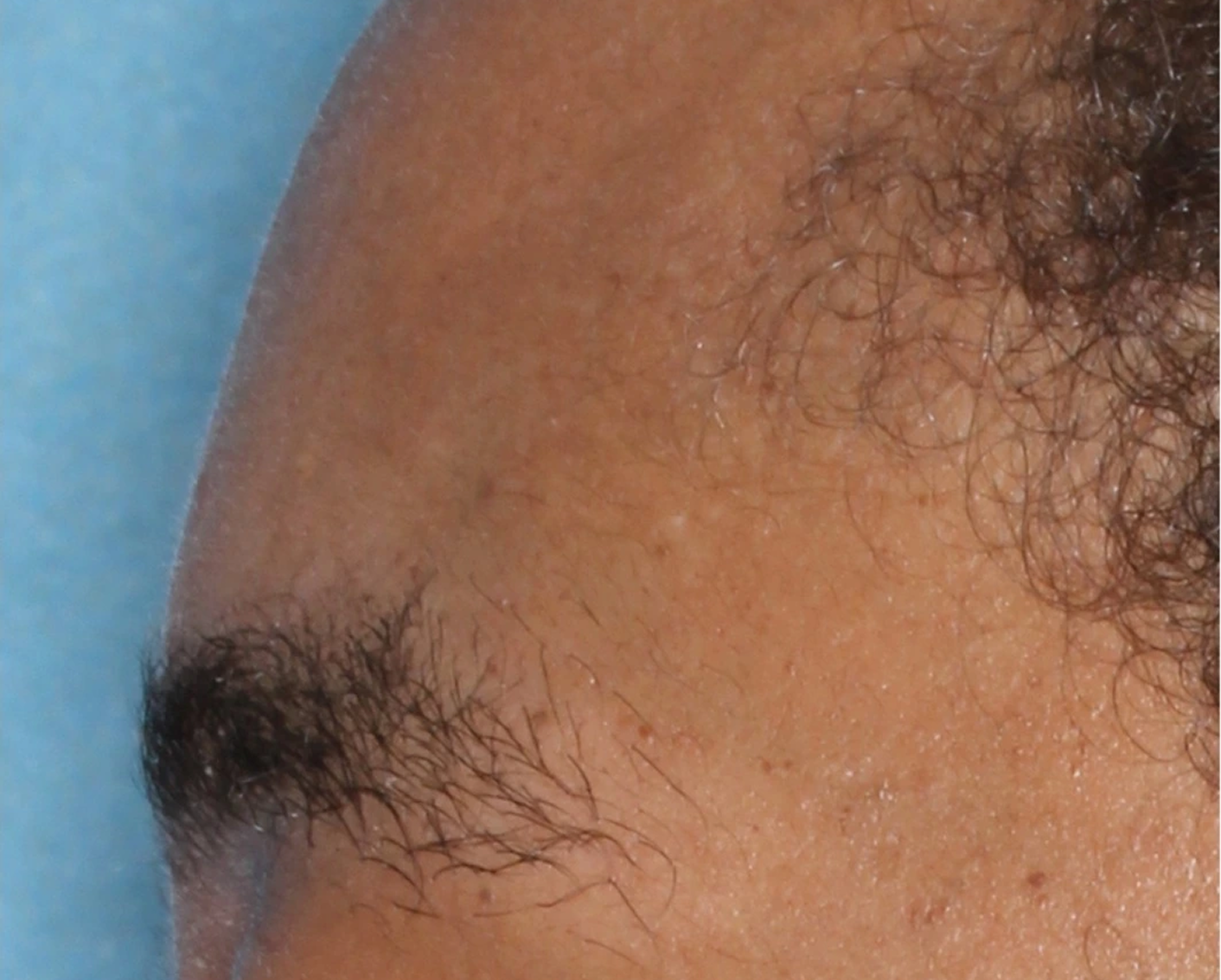 Image of eyebrow at week 4