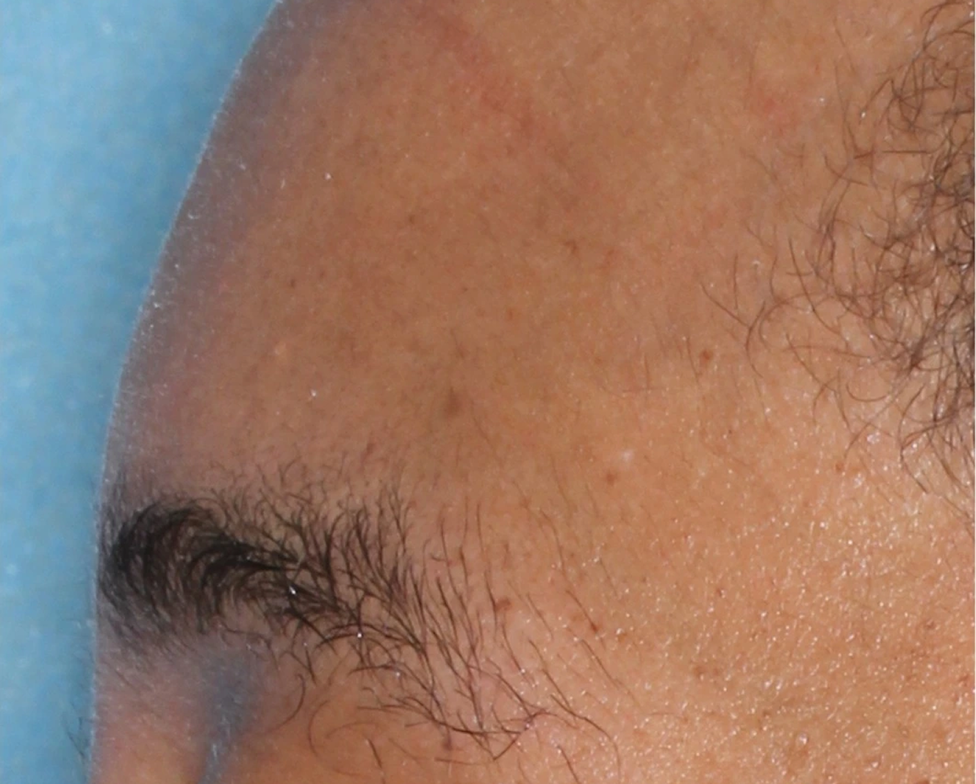 Image of eyebrow at week 8